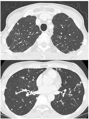 Frontiers Case Report Irinotecan Induced Interstitial Lung Disease